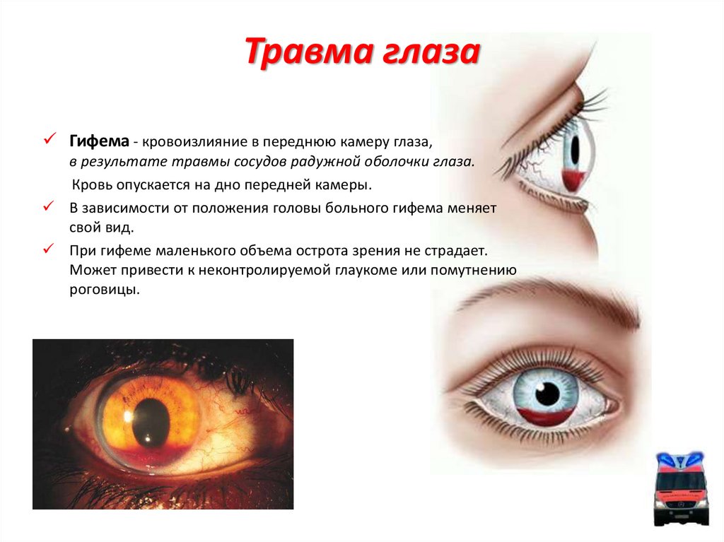 Заболевание и повреждение глаз биология 8 класс. Механическая травма глаза. Механическое повреждение глаза.