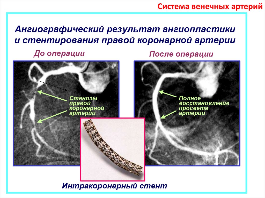 Стентирование сосудов последствия