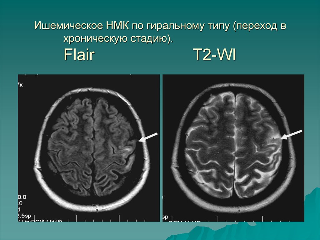 Глиозные изменения белого вещества головного мозга