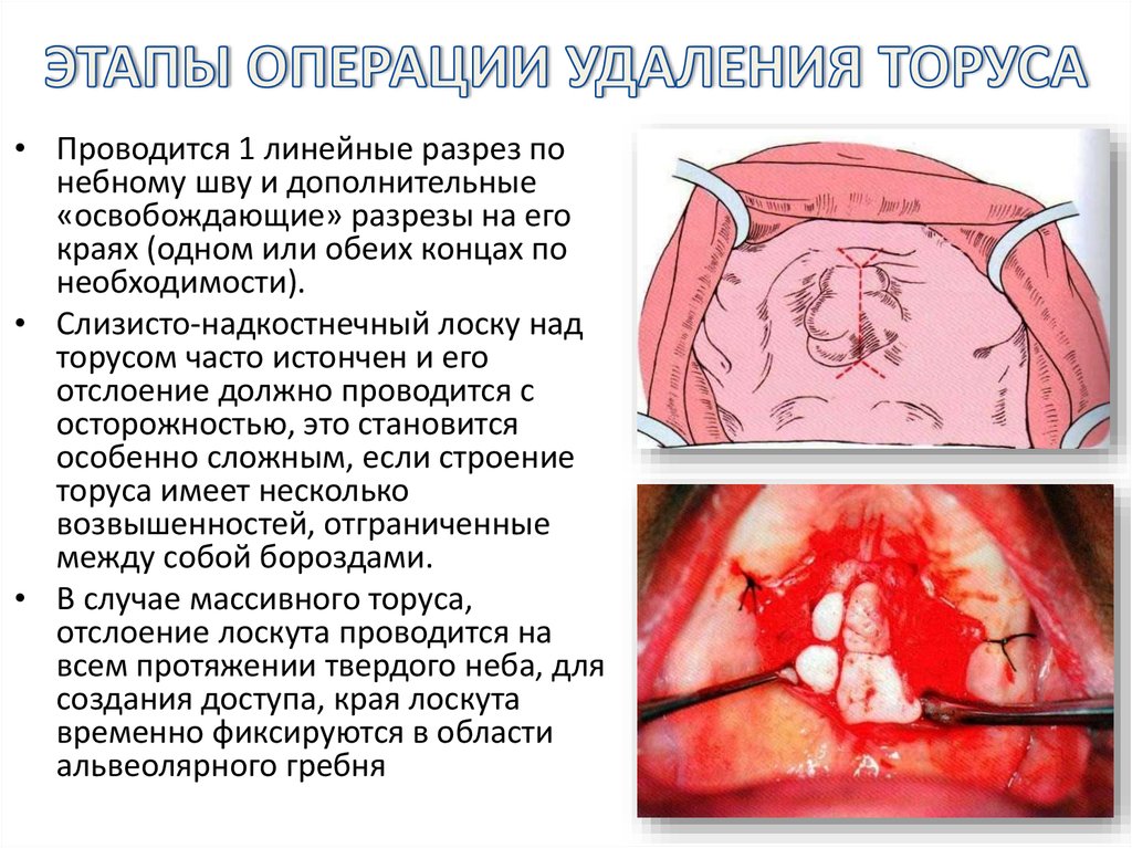 ЭТАПЫ ОПЕРАЦИИ УДАЛЕНИЯ ТОРУСА