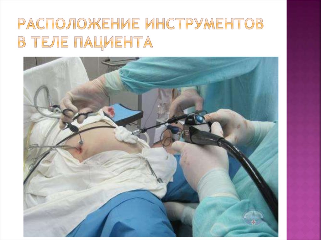 Расположение инструментов в теле пациента