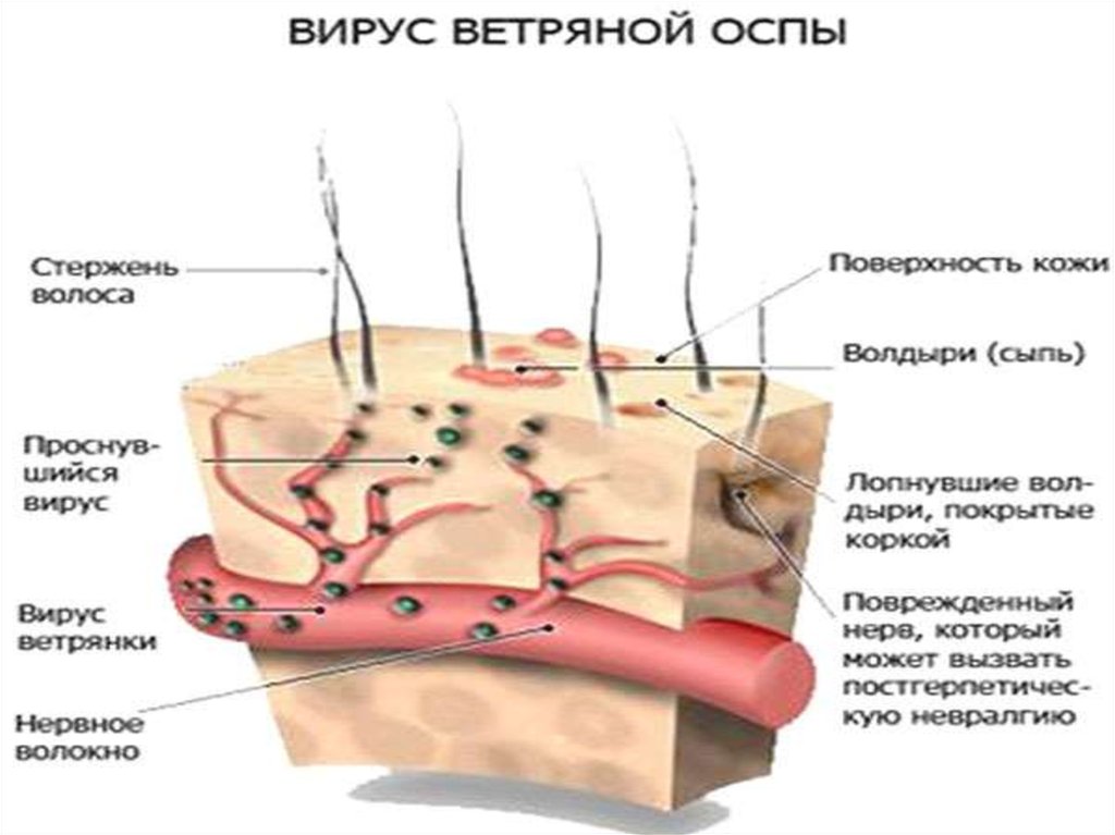 Осложнения ветряной оспы. Ветряная оспа механизм. Ветряная оспа фон кожи. Механизмом передачи ветряной оспы является.