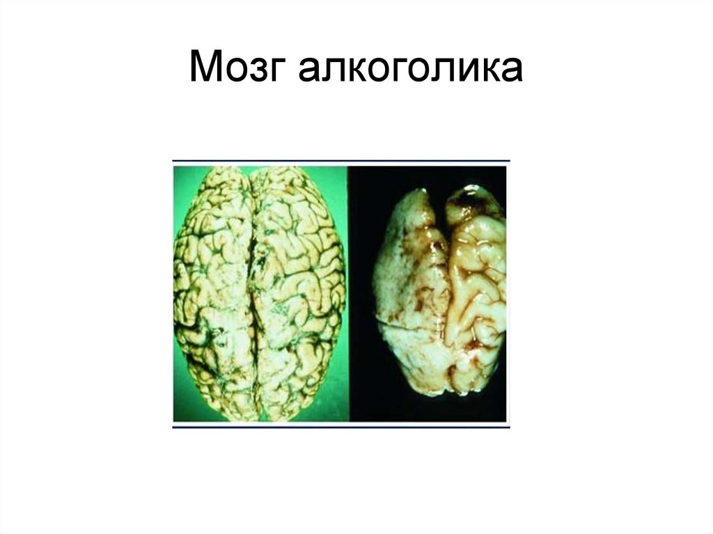 Головной мозг пьющего. Головной мозг алкоголика и здорового. Мозг здорового человека и алкоголика. Органы здорового человека и алкоголика.