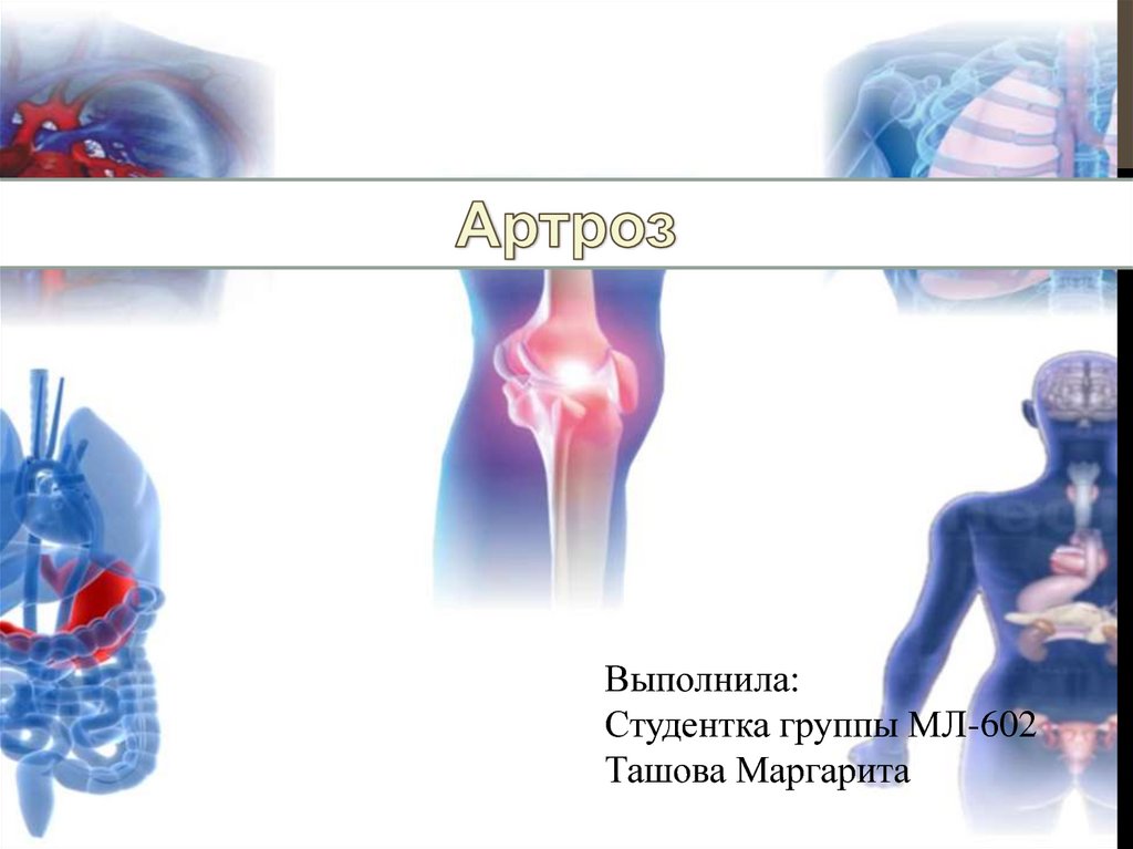 Артроз плеча симптомы и лечение. Спутник осложнения