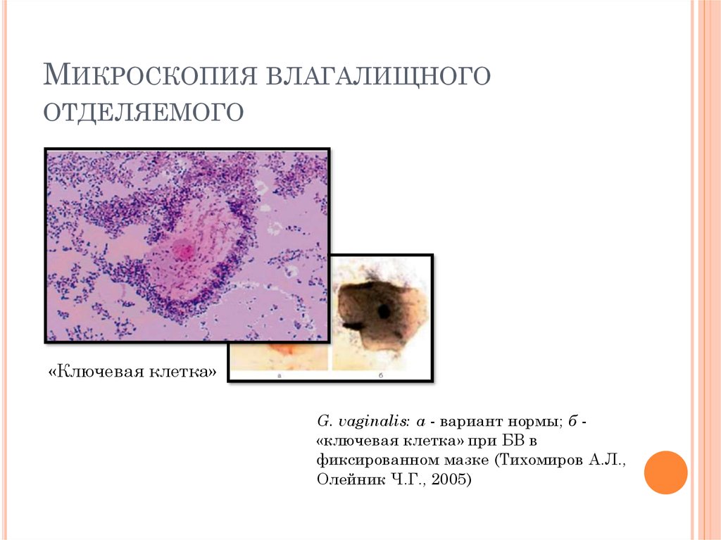 Баквагиноз что это. Бактериальный вагиноз мазок микроскопия. Ключевые клетки при бактериальном вагинозе. Микроскопия влагалищного отделяемого. Ключевые клетки при микроскопии.