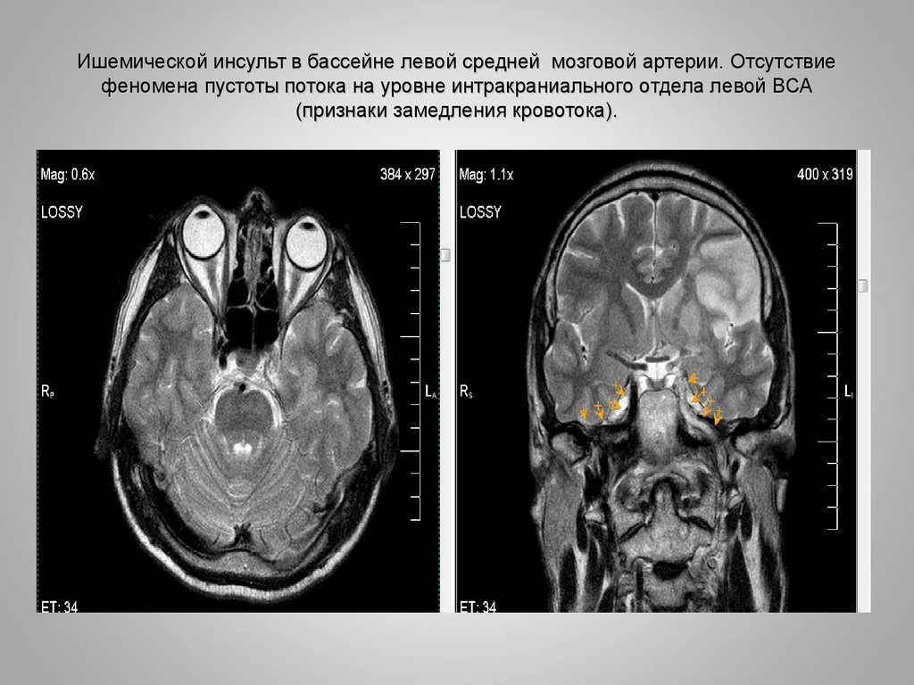 Левая средняя мозговая артерия инсульт. Ишемический ОНМК мрт. ОНМК В бассейне СМА. Инсульт в бассейне средней мозговой артерии.