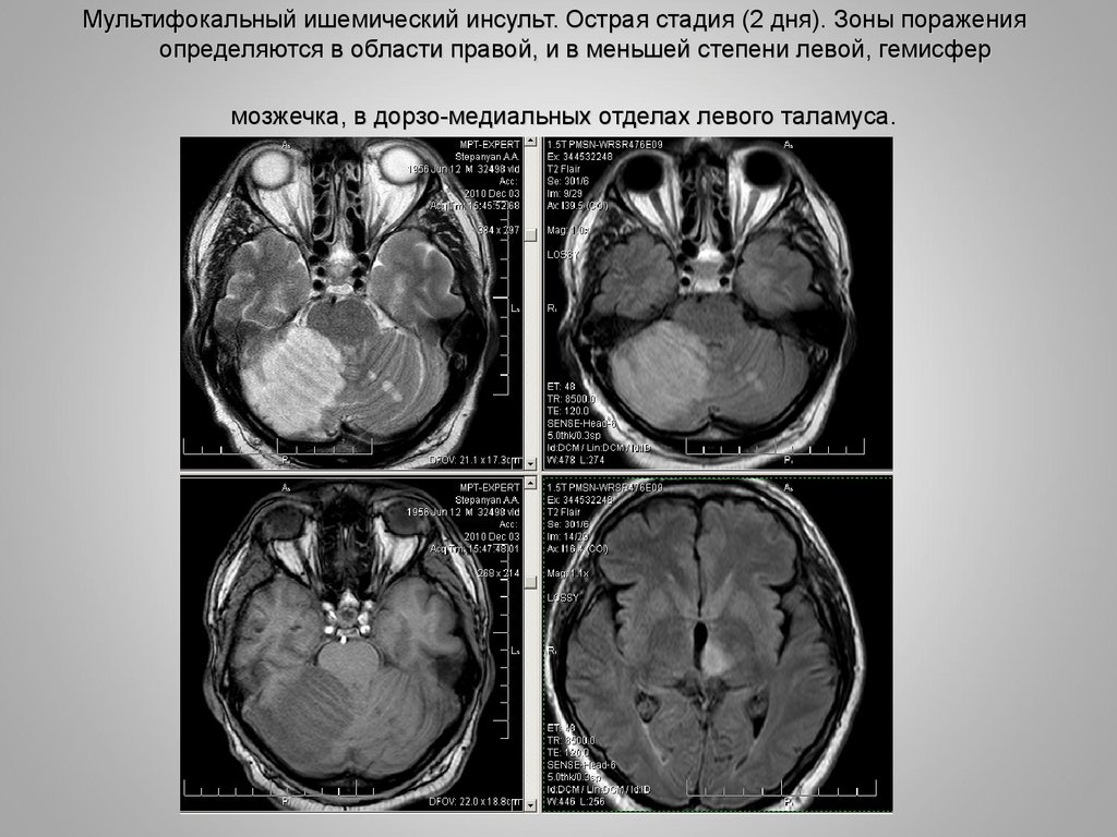Гемисферы мозжечка изменение. Ишемический инсульт мозжечка кт. Мультифокальный инсульт.
