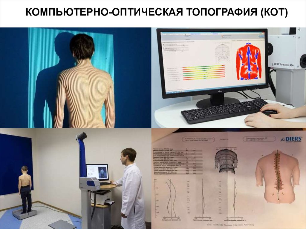 Компьютерный оптический топограф. Компьютерная оптическая топография. Компьютерная оптическая топография позвоночника. Компьютерное оптическое обследование позвоночника.