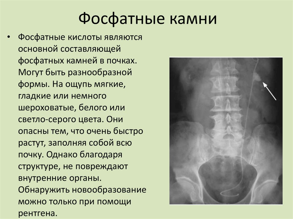 Плотность конкремента в почке. Плотность конкрементов почек. Плотность фосфатных камней в почках. Плотность камней в почках на кт.