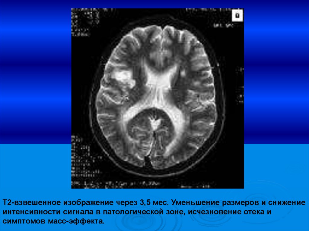 Снижение интенсивности сигнала. Т2 взвешенное изображение. Зона патологической интенсивности сигнала мрт. Зона повышенной и пониженной интенсивности сигнала на мрт. Признаки масс эффекта на мрт.