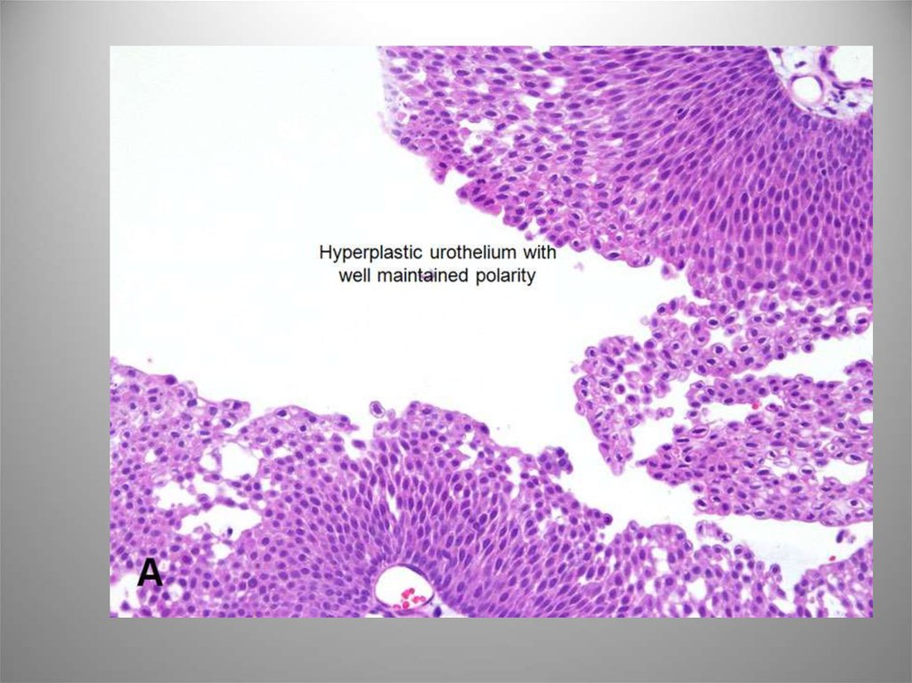 Карцинома low grade мочевого. Уротелиальная карцинома мочевого пузыря гистология. Уротелиальная карцинома гистология. Уротелиальная карцинома почки гистология. Уротелиальная папиллома микропрепарат.