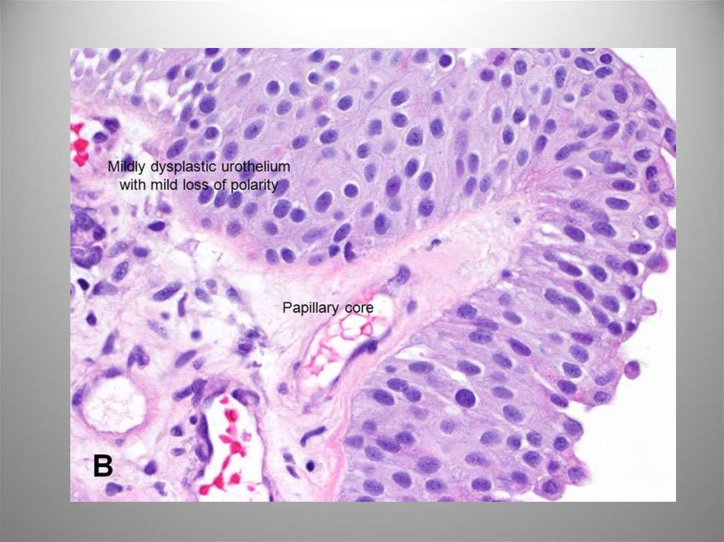 Карцинома low grade мочевого. Уротелиальная карцинома мочевого пузыря гистология. Уротелиальная карцинома гистология. Уротелиальная карцинома цитология. Аденокарцинома мочевого пузыря гистология.