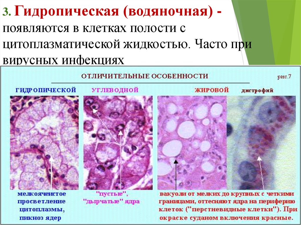 Схема паренхиматозные дистрофии морфологические проявления