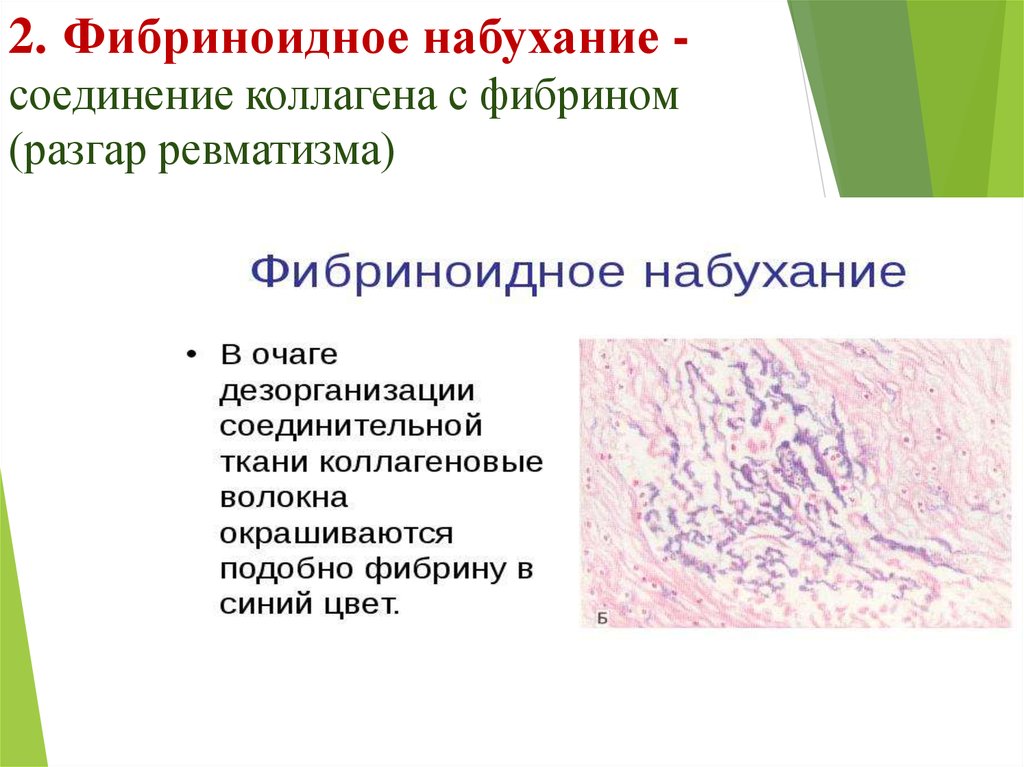 Фибриноидное набухание это. Фибриноидное набухание патанатомия. Фибриноидное набухание соединительной ткани. Фибриноидное набухание соединительной ткани микропрепарат. Фибриноидное набухание соединительной ткани пикрофуксин.