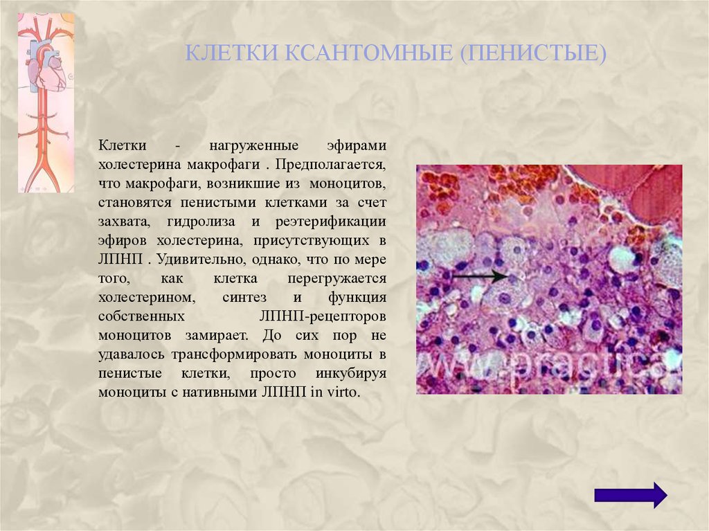 Железо в макрофагах. Ксантомные клетки гистология. Ксантомные клетки микропрепарат. Пенистые клетки. Пенистые клетки и ксантомные клетки.