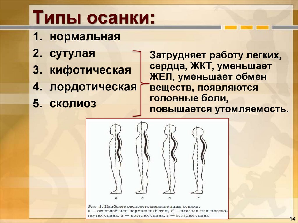 Назовите какие виды людей. Кифотическая осанка и сутулая. Типы осанки человека. Типы нарушения осанки. Виды неправильной осанки.