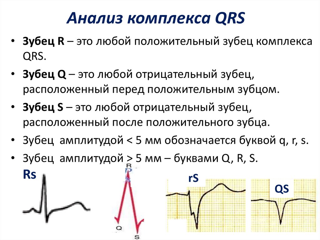 Низкоамплитудная экг что это значит. Патологический комплекс QRS на ЭКГ. Анализ комплекса QRS на ЭКГ. Комплекс QRS на ЭКГ норма. Комплекс зубцов QRS характеризует.
