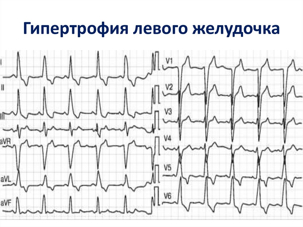 Глж сердца. Гипертрофия миокарда левого желудочка на ЭКГ. Гипертрофия желудочков на ЭКГ. Гипертрофия миокарда левого желудочка сердца на ЭКГ. Гипертрофия желудочков сердца на ЭКГ.