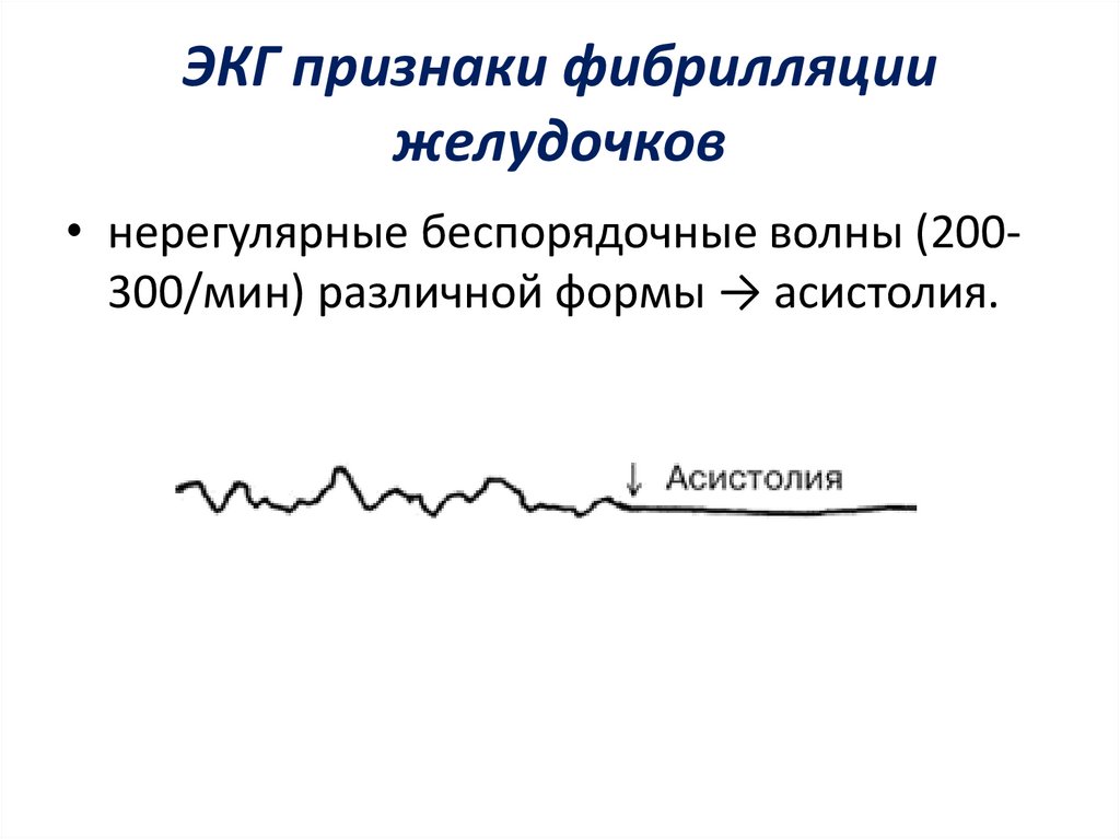 Фибрилляция желудочков на экг картинки