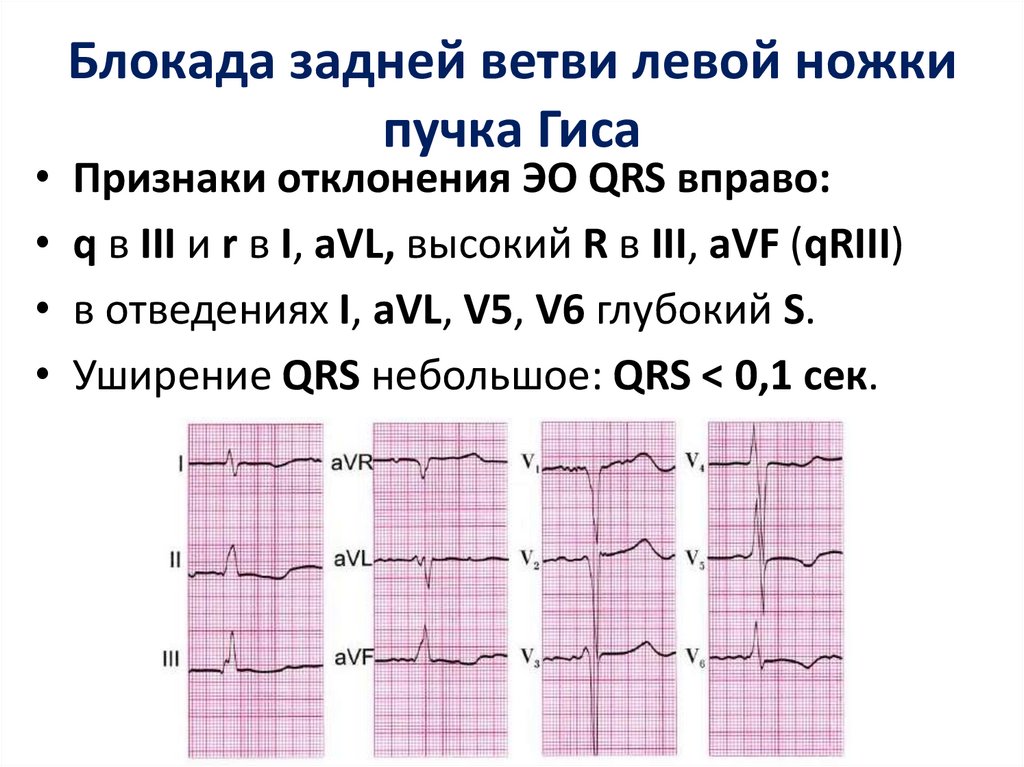 Блокада левой ножки гиса экг. ЭКГ при блокаде левой ножки пучка Гиса. Неполная блокада левой ножки пучка Гиса на ЭКГ. Признаки неполной блокады левой ножки пучка Гиса на ЭКГ. Блокада левой ножки пучка Гиса на ЭКГ.