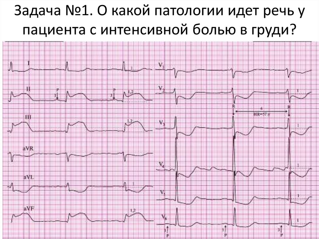 Фото экг с инфарктом