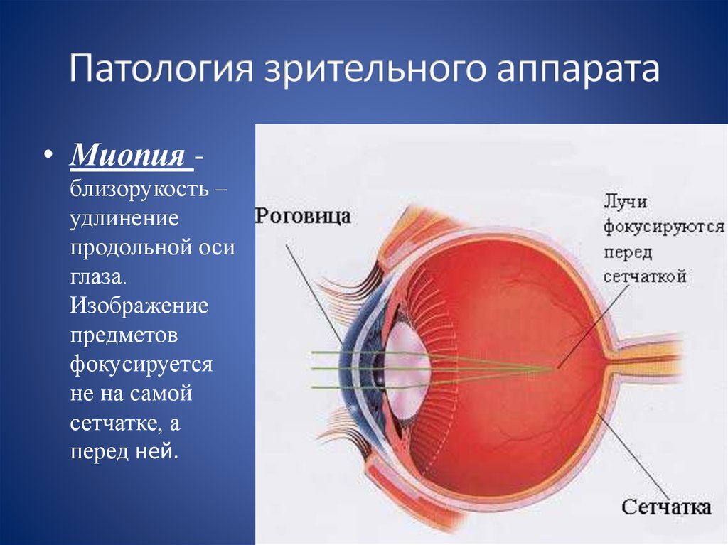 Миопия сетчатки. Близорукость строение глазного яблока. Анатомия глаза миопия. Строение глаза миопия. Анатомия глаза близорукость и дальнозоркость.