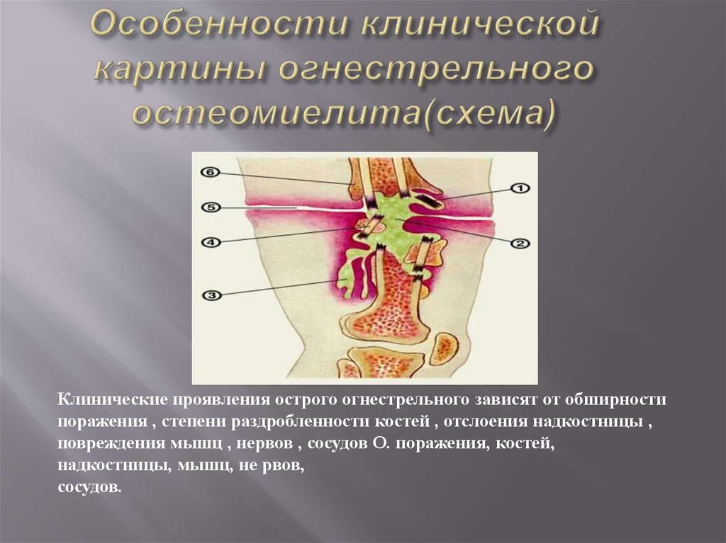 Особенности клинической картины огнестрельного остеомиелита(схема)