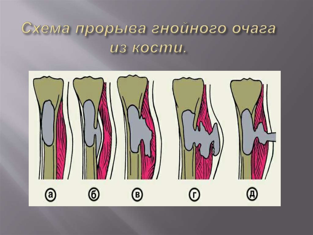 Схема прорыва гнойного очага из кости.