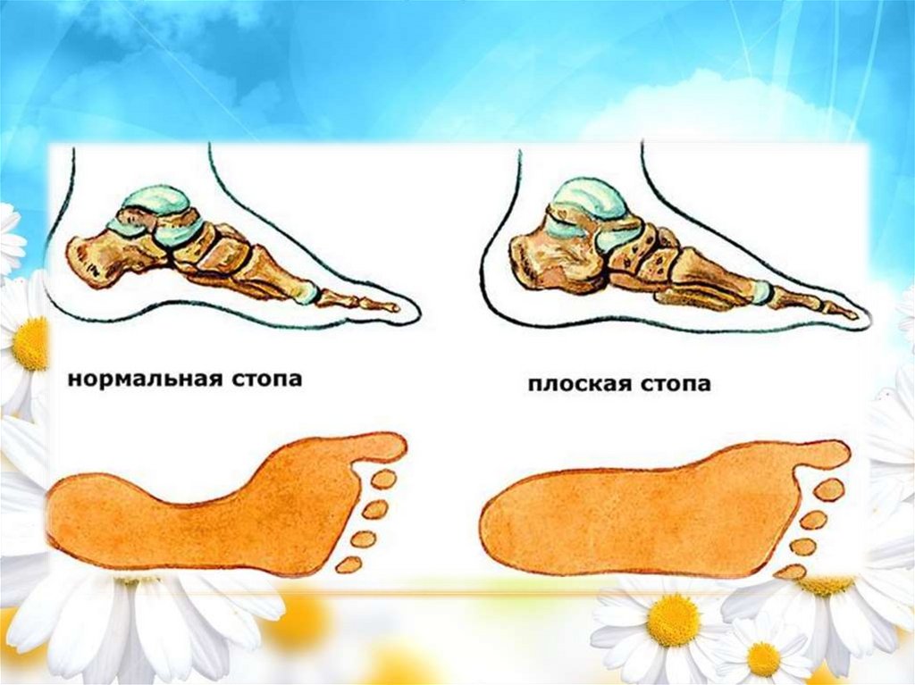 Правильные стопы ног. Сводчатая стопа и плоскостопие. Стопа нормального человека и плоскостопие. Плоскостопие анатомия стопы. Свод стопы плоскостопие анатомия.