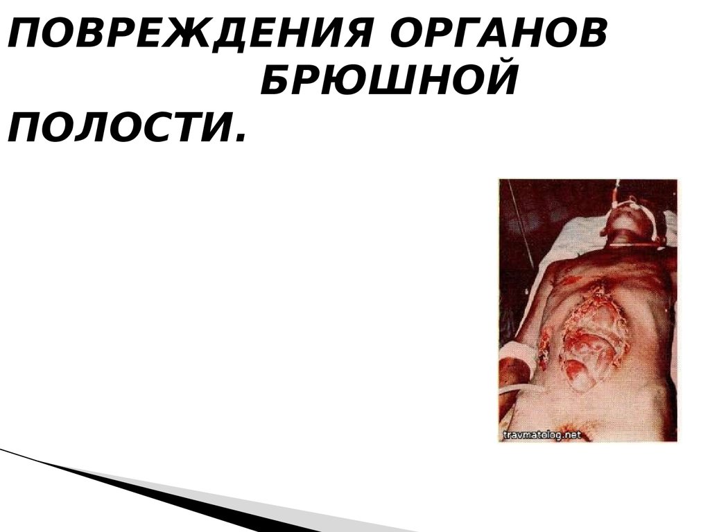 Повреждения органов брюшной полости.