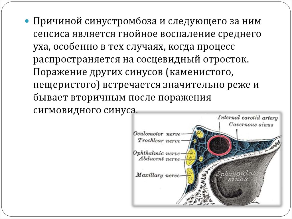 Тромбоз кавернозного синуса