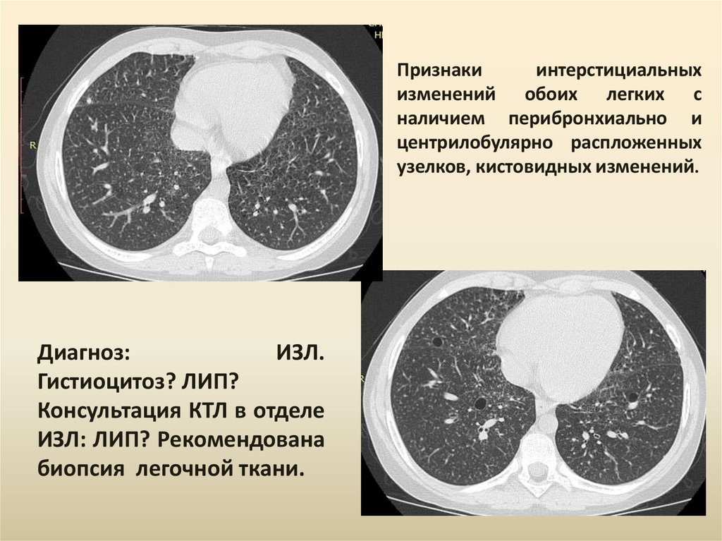 Интерстициальные заболевания. Интерстициальные заболевания лёгких кт. Интерстециальные заболевания лёгких кт. Интерстициальные изменения в легких на кт. Кт при интерстициальных изменениях в легких.