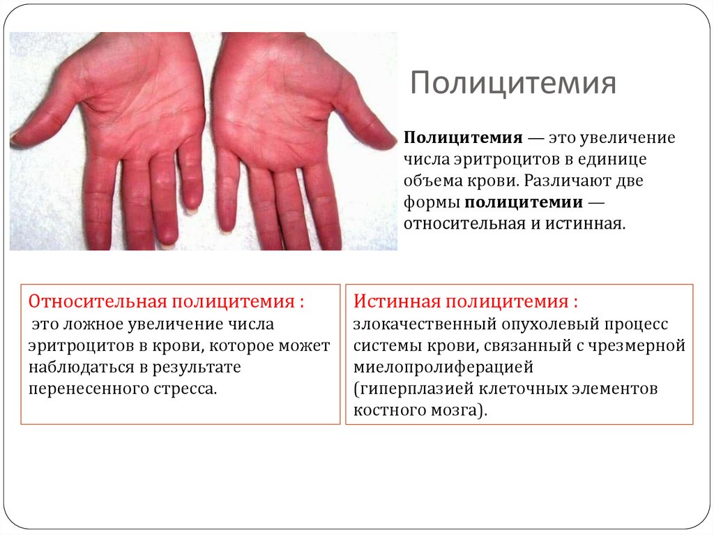 Полицитемия