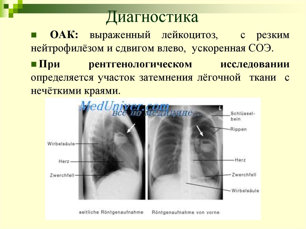 Легкие диагнозы. Презентация на тему абсцесс легкого. Презентация на тему абсцесс. Показатели крови при абсцессе легкого.