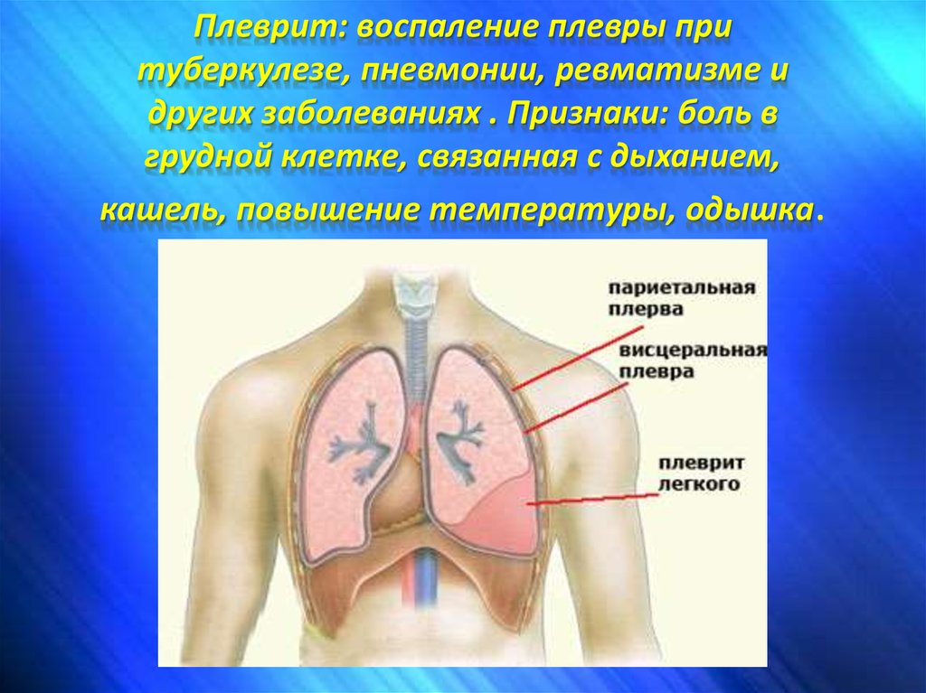 Питание при плеврите легкого картинки