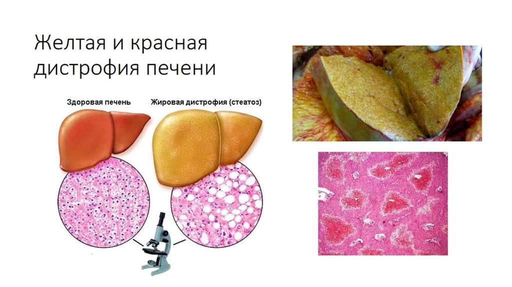 Желтая и красная дистрофия печени