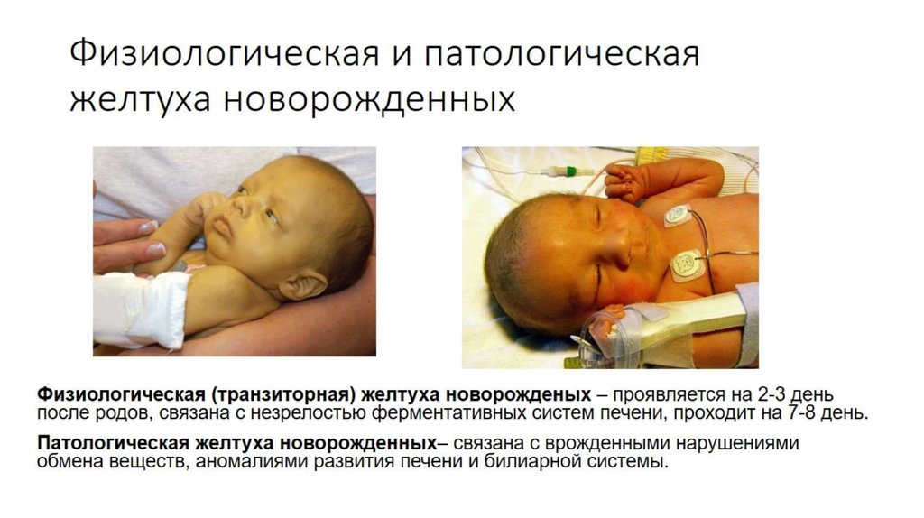 Физиологическая и патологическая желтуха новорожденных