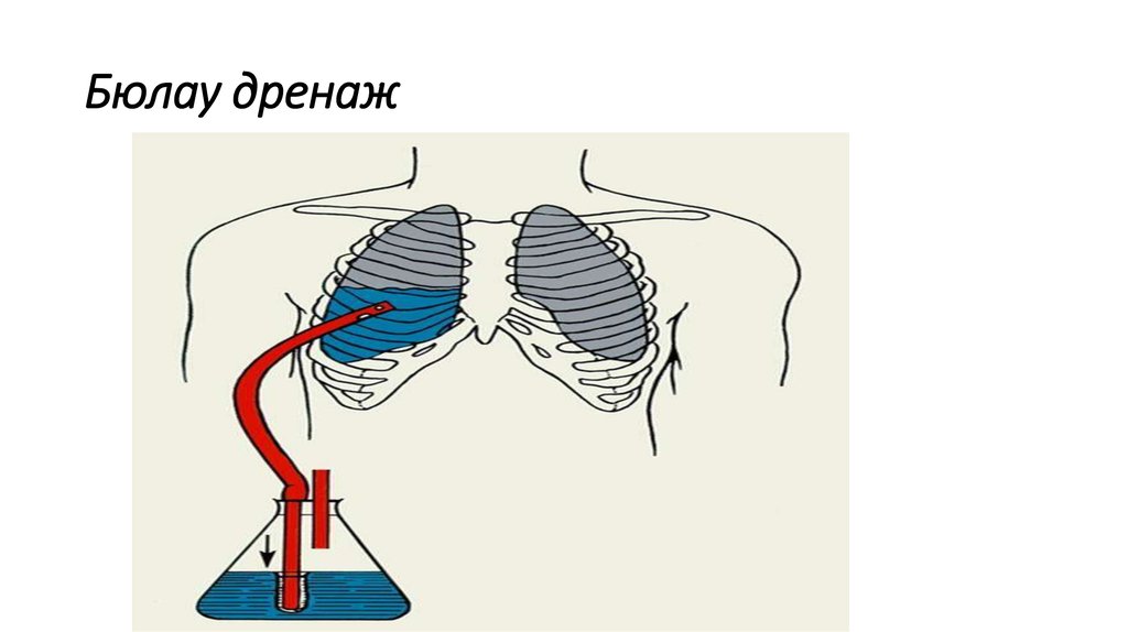 Бюлау дренаж