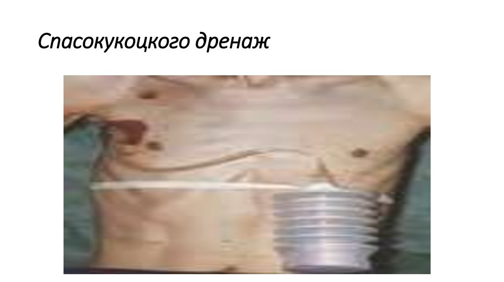 Спасокукоцкого дренаж