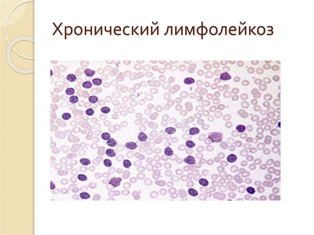 Что такое лимфолейкоз. Лимфолейкоз гистология. Хронический лимфолейкоз патогенез. Печень при хроническом лимфолейкозе рисунок. Хронический лимфолейкоз гистология.