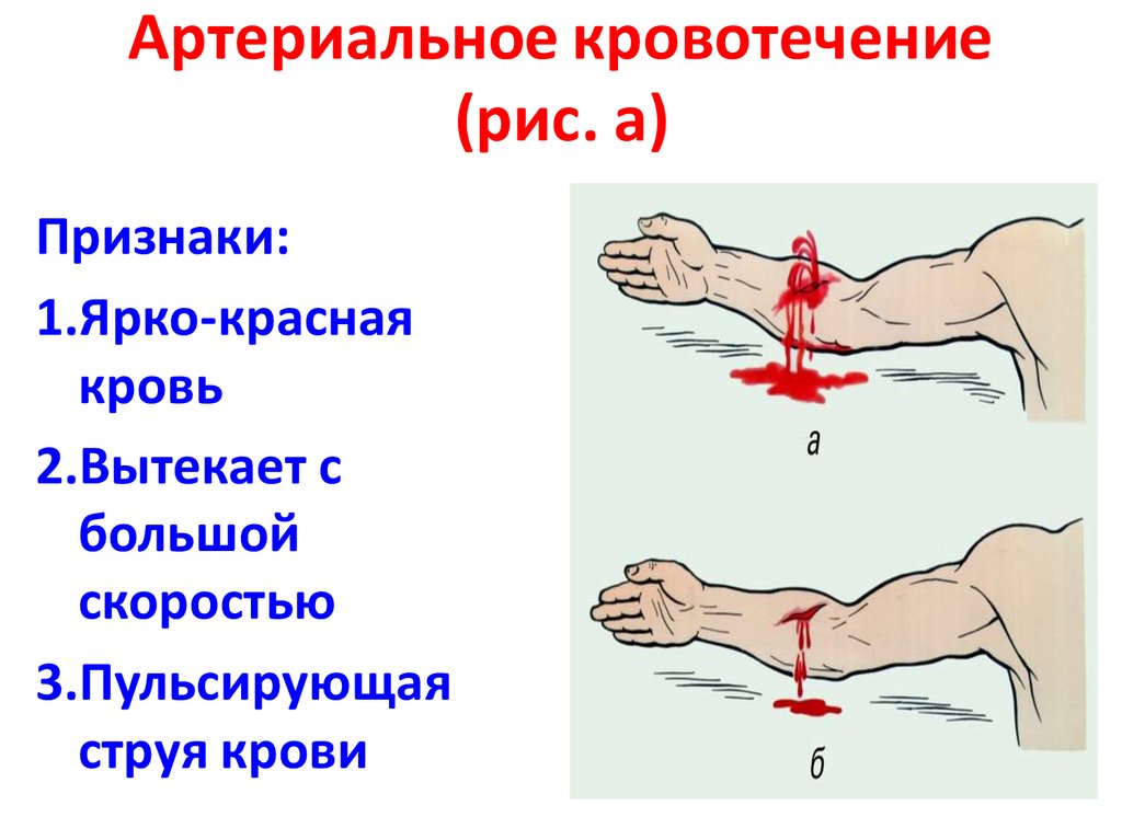 Артериальное кровотечение (рис. а)