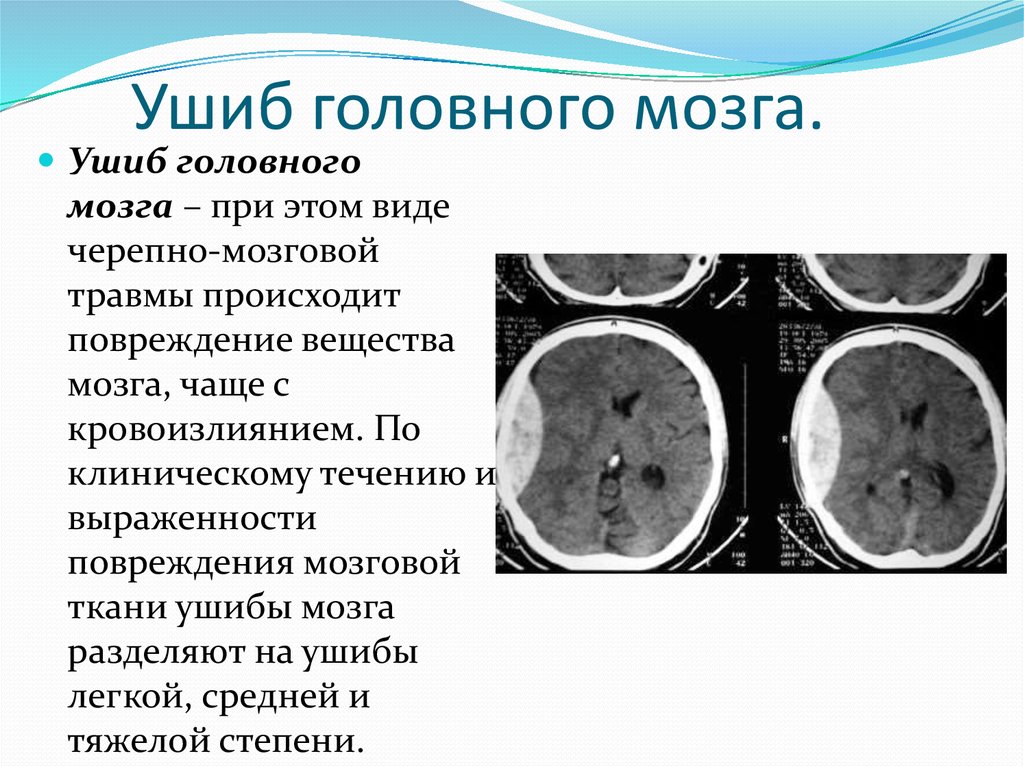 Повреждения головного мозга возникают. Повреждение вещества головного мозга. Закрытые травмы головного мозга. При ушибе головного мозга.