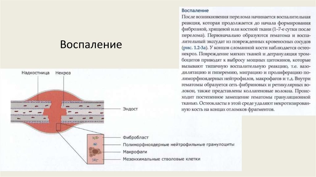 Переломы травматология презентация