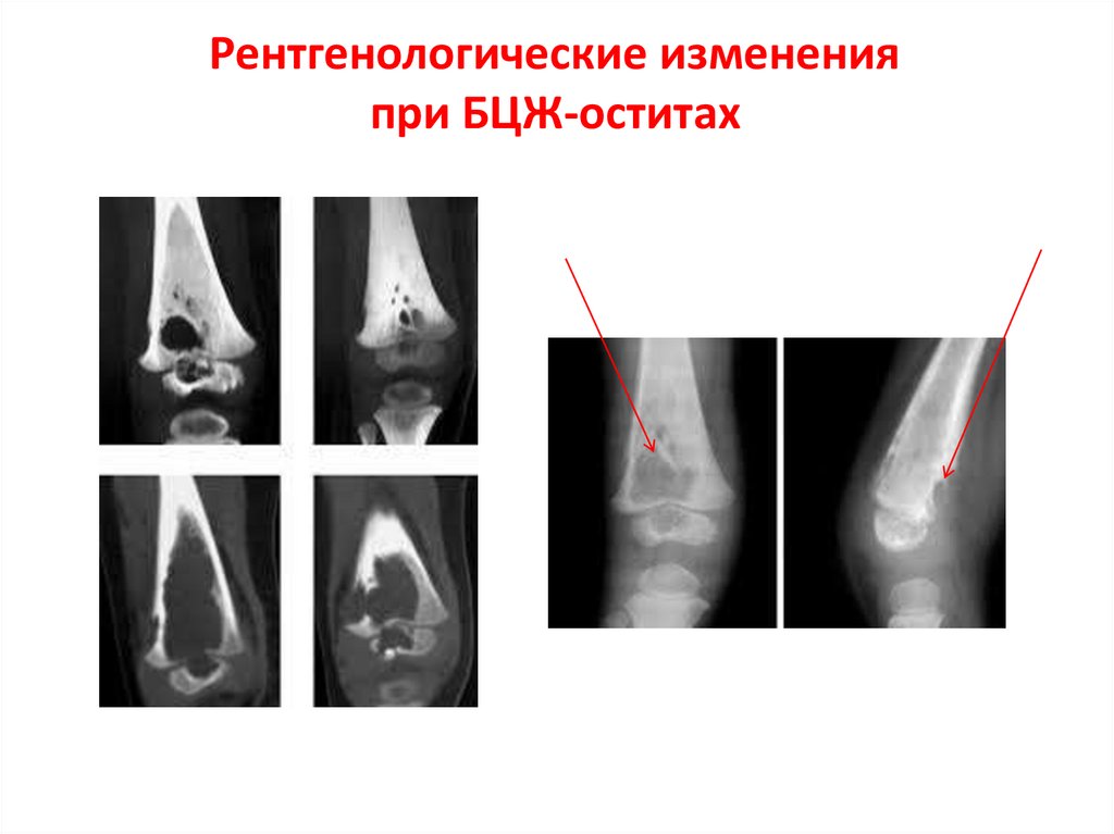 Рентгенологические изменения при БЦЖ-оститах