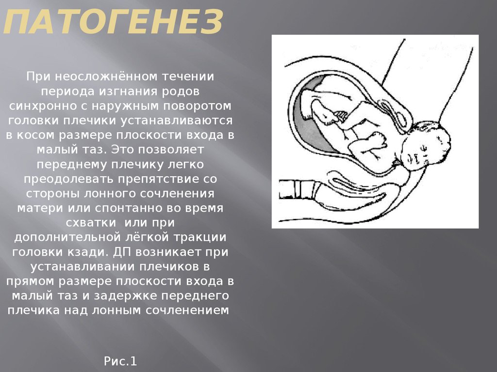 Дистоция плечиков презентация