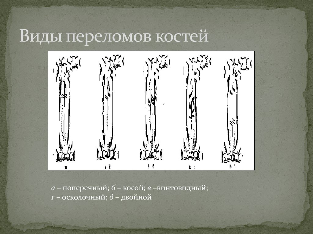 Виды переломов костей