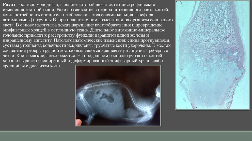 Болезнь молодых. Рахит патологическая анатомия. Заболевание костей презентация. Дистрофические заболевания костной ткани.