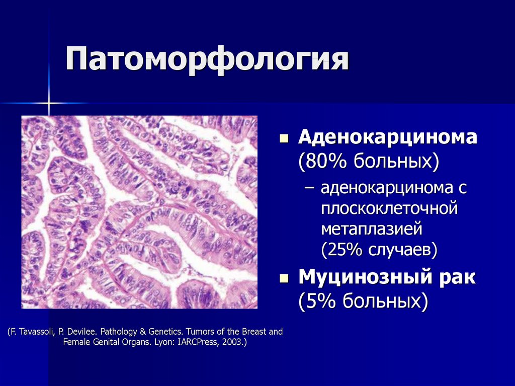 Аденокарцинома морфология