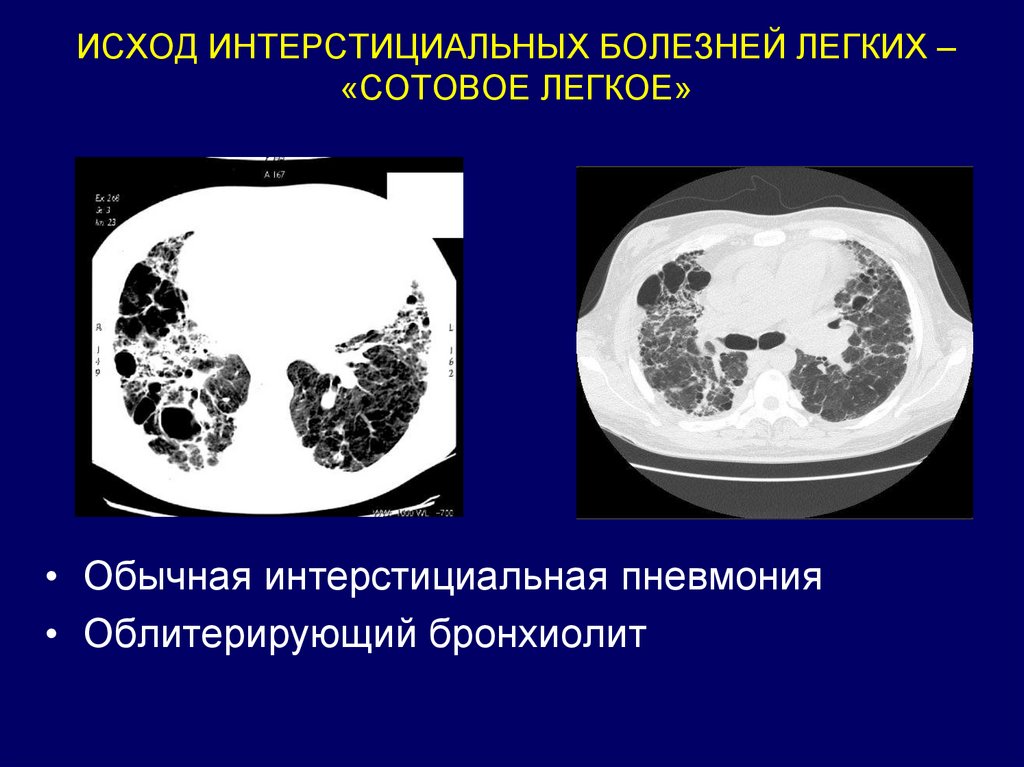 Презентация интерстициальные заболевания легких