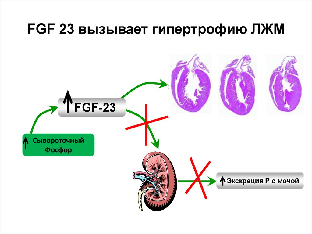 FGF 23 вызывает гипертрофию ЛЖМ